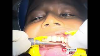 Retained Deciduous Extraction dentist dentistry trending youtube oralsurgery [upl. by Aimahs150]