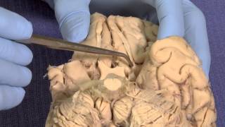 Olfactory Neuroanatomy Video Lab  Brain Dissections [upl. by Nofets703]