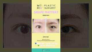 Blepharoplasty mihoplasticsurgerykorea4827 [upl. by Peedus299]