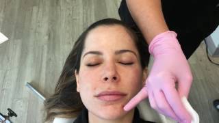 Demonstration of Chemical Peel [upl. by Pogue]