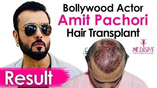 Celebrity Amit Pachori Hair Transplant in India  Advance Procedure amp Results  Medispa Jaipur India [upl. by Dream225]