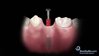 Tissue Level implant and UCLA Abutment [upl. by Rednijar]