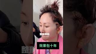 Face lifting looks good trending fyp facelift facelift rhinoplasty PlasticSurgeon viral 整形 [upl. by Ecirtnas]