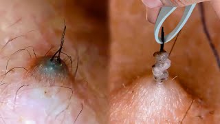 How to Prevent amp Treat Ingrown Hairs [upl. by Alfeus]