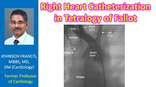 Right Heart Catheterization in Tetralogy of Fallot [upl. by Eskill724]