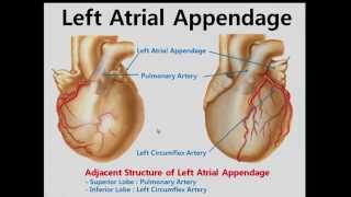 Cardiac Anatomy and Electric Mapping for Ablation of Atrial Fibrillation [upl. by Lyrehc]