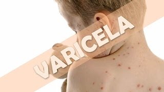 VARICELA16 COSAS QUE DEBERÍAS VARICELA EN NIÑOS SIGNOS SINTOMAS TRATAMIENTO PREVENCIÓNENARM [upl. by Alaik803]