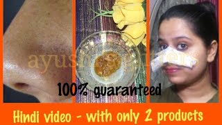 ब्लैक हेड्स हमेशा के लिए हटाने का सबसे अच्छा तरीका  BEST WAY TO REMOVE BLACKHEADS PERMANENTLY [upl. by Airetahs]