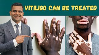 Vitiligo Leucoderma  Can Be Treated  Herbs And Vitamins To Treat Vitiligo  Dr Vivek Joshi [upl. by Ruon]