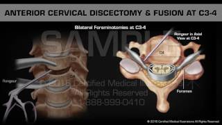 Anterior Cervical Discectomy amp Fusion at C34 [upl. by Rachel]