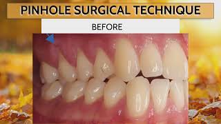 Dr Nemeths Success in Reversing Gum Recession 🦷 🔄 [upl. by Nnitsuj]