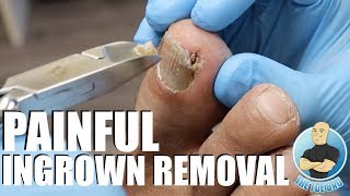 TREATING AN EXTREMELY PAINFUL INGROWN TOENAIL WITH HOW TO ADVICE [upl. by Hobie751]