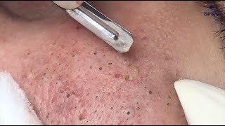 Full Blackhead Popping Video  HOT 2019  Part 2  Continue [upl. by Edorej]