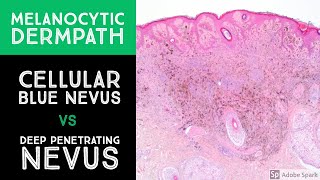 Melanocytic Dermpath Cellular Blue Nevus vs Deep Penetrating NevusMelanocytoma [upl. by Ulane]