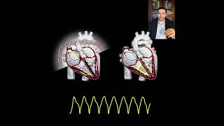 Wide vs Narrow QRS complex in Arrhythmias Shorts [upl. by Narhet]