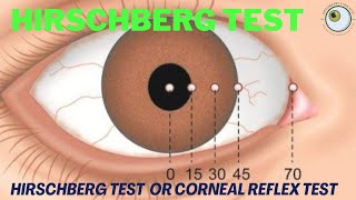 hirschberg corneal reflex tes  how to perform hirschberg test  hirschberg test explained [upl. by Theone]