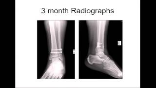 Distal tibia and ankle fractures  Panel discussion [upl. by Ecitnirp]