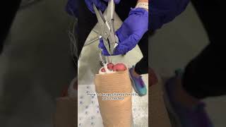 Removing Pins From Toes Hammertoes [upl. by Ylil]