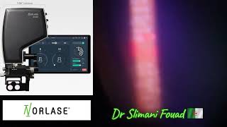 laser norlase écho multispots micropulse [upl. by Lody]