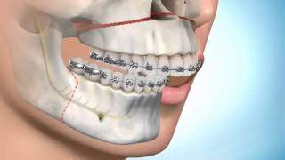 Chirurgie Maxillofaciale et orthodontie [upl. by Entwistle]