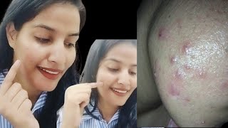 Acne amp Acne Scars Daily Skincare skincare [upl. by Socha416]