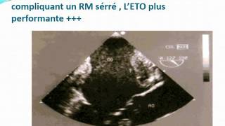 SEMIOLOGIE Etude Synthétique de la Sémiologie cardio vasculaire [upl. by Diet]