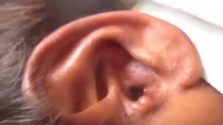 Ear botfly Botfly extraction human YouTube [upl. by Sanger791]