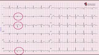 An ECG pattern in regression [upl. by Brown]