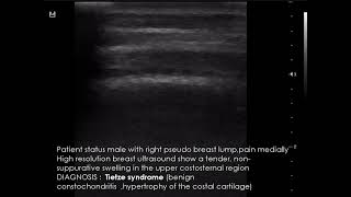 CASE 956 Tietze syndrome [upl. by Dijam313]