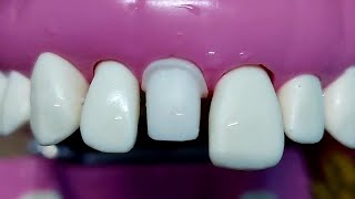 ازاى تعمل Reduction بسهوله  All ceramic crown preparation for upper central upper1drghazal [upl. by Claire]