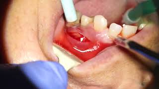 TOOTH ABSCESS DRAINAGE [upl. by Nawuq]