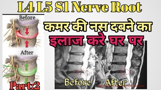 L4 L5 S1 nerve root compression exercises  buldging Disc exercises  Herniated Exercise  in hindi [upl. by Adnalue]