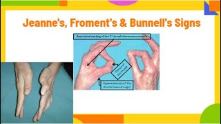 jeannes froments amp Bunnells signs  ulnar neuropathy PhysiotherapyKnowledge [upl. by Kcirneh]