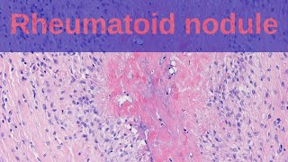 What are Rheumatoid Nodules  Pathology mini tutorials [upl. by Remas224]