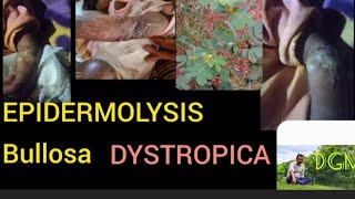 EPIDERMOLYSIS BULLOSA DYSTROPICAAYURVEDA [upl. by Chor719]