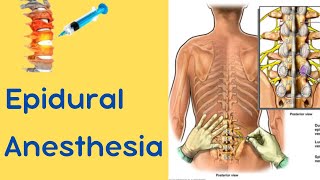 Epidural Anesthesia [upl. by Gamal]