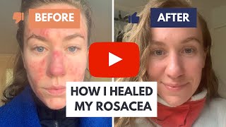 How I Healed My Rosacea The Solution Dermatologists Dont Want You to Know About [upl. by Nylecsoj]