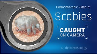 Dermoscopy of Crusted Scabies [upl. by Ivory837]