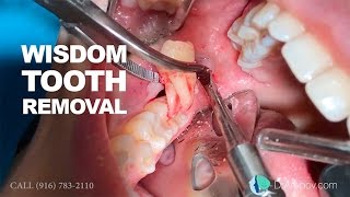 Wisdom tooth removal in 5 MIN or less Surgical Guide Online Course  Free eBook [upl. by Oigres262]