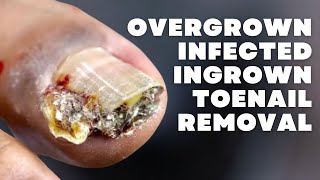 OVERGROWN INFECTED INGROWN TOENAIL REMOVAL WITH A SUPER SURPRISE [upl. by Laiceps959]