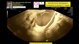 Heterotopic Pregnancy  Intrauterine normal 6 weeks vs Ruptured Ectopic Pregnancy [upl. by Ylevol88]