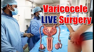 Non Surgical Treatment of Varicocele  Varicocele LIVE Surgery Embolization  Dr Shailesh Kumar [upl. by Ainevul31]