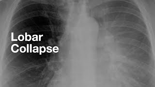 Lobar Collapse examples of each lobe [upl. by Goldenberg]