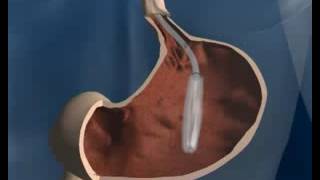 Gastric Balloon Placement [upl. by Ydnas]