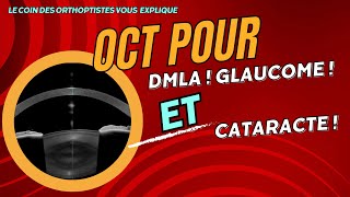 Pourquoi faire un OCT  pour le Glaucome la DMLA la Cataracte Ophtalmologie Orthoptie [upl. by Alameda467]