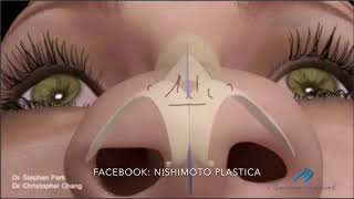 Rinoplastia em pessoas com nariz Largo e ponta mal definida [upl. by Anadroj237]