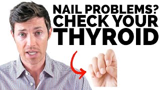 What Your Nails Tell You About Your Thyroid Health [upl. by Semele]