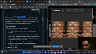 Neurology and Ophthalmology InterNuclear Ophthalmoplegia INO MLF lesion [upl. by Holland]