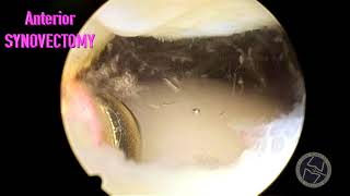 SYNOVIAL PLICA IN LEFT KNEE [upl. by Zonnya747]