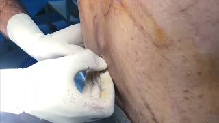 How to perform Spinal Anesthesia  Steps of spinal anesthesia Regional anesthesia [upl. by Alston]